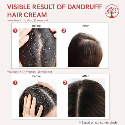 Ivory Natural Dandruff Hair Cream For Dandruff, And Nourishing Dry Scalp
